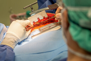 A chief physician in cardiac surgery uses an electronic scalpel to expose a vein in order to be...