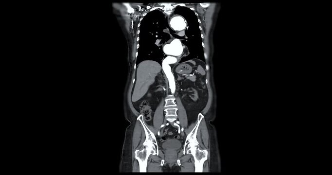 CTA Whole aorta Coronal view.