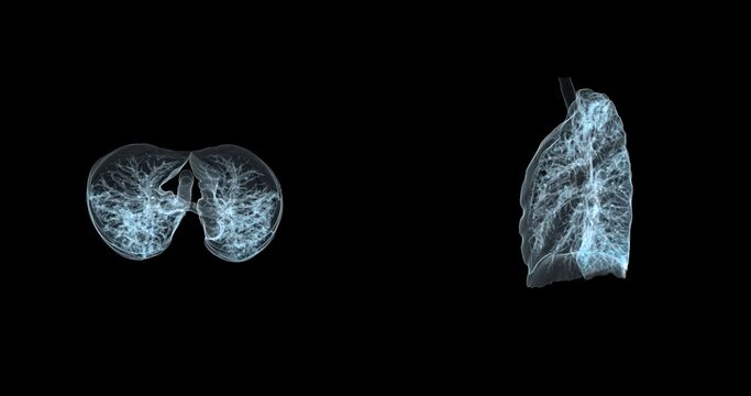 CT Chest or Lung 3D rendering  for diagnosis TB,tuberculosis and covid-19 .