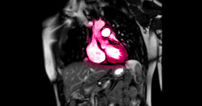 MRI heart or Cardiac MRI ( magnetic resonance imaging ) of heart in Vertical long axis view showing heart beating for detecting heart disease.