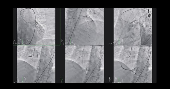 Cardiac catheterization showing coronary arteries for diagnosis cardiac arrest .