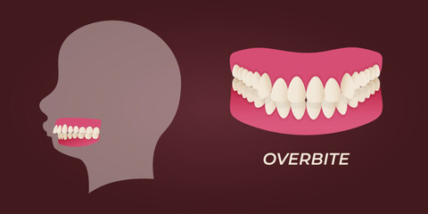 Human teeth malocclusion set with realistic images of mouth jaws with crooked teeth and text captions. Normal and abnormal occlusion. Vector illustration