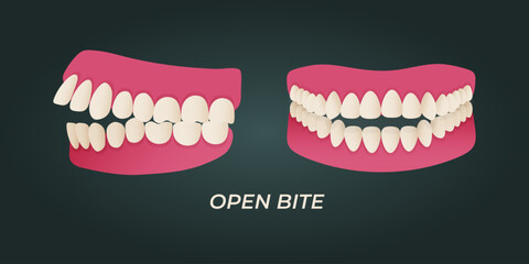 Human teeth malocclusion set with realistic images of mouth jaws with crooked teeth and text captions. Normal and abnormal occlusion. Vector illustration