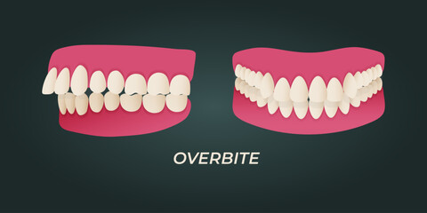 Human teeth malocclusion set with realistic images of mouth jaws with crooked teeth and text captions. Normal and abnormal occlusion. Vector illustration - obrazy, fototapety, plakaty