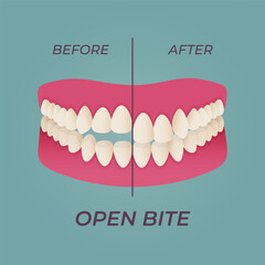 Medical dental diagram illustration. Orthodontist human tooth anatomy. Vector infographics with teeth diagrams.