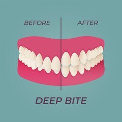 Medical dental diagram illustration. Orthodontist human tooth anatomy. Vector infographics with teeth diagrams.