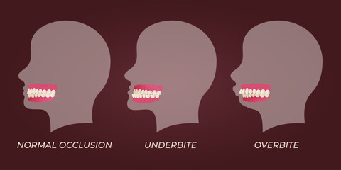 Human teeth malocclusion set with realistic images of mouth jaws with crooked teeth and text captions. Normal and abnormal occlusion. Vector illustration