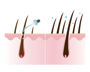 Hair density treatment vector illustration isolated on white background. - obrazy, fototapety, plakaty
