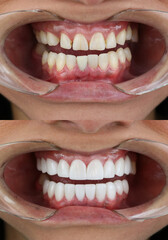 smile makeover porcelain laminate veneers result before and after