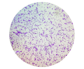 Essential thrombocytosis blood smear showing abnormal high volume of platelet and White Blood Cell analyze by microscope.