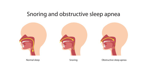 Snoring and obstructive sleep apnea - obrazy, fototapety, plakaty