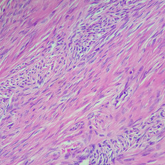 Camera photo of ovarian fibroma, showing proliferative spindle cells with fascicular pattern, magnification 400x, photograph through a microscope