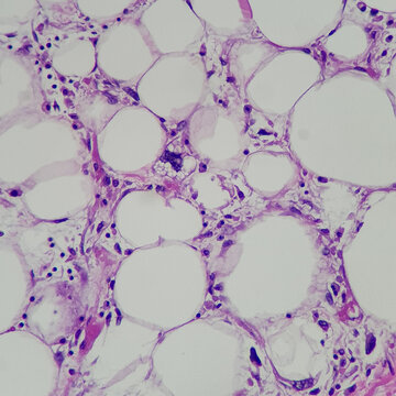 Camera photo of lipoblast in liposarcoma, showing vacuolated cytoplasm and scalloping nuclei, magnification 400x, photograph through a microscope