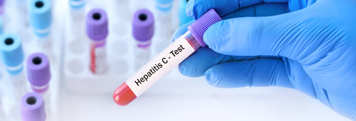 Naklejka premium The doctor holds a test blood sample tube positive with hepatitis C virus (HCV) test on the background of medical test tubes. Banner