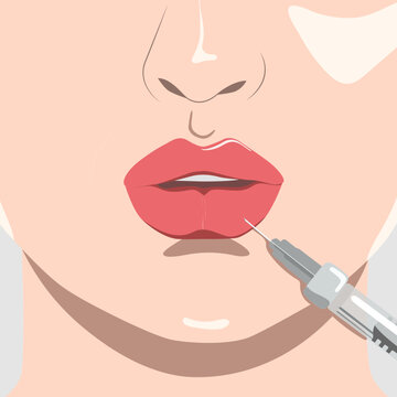 Cosmetologist does lip augmentation procedure of a beautiful woman. Cosmetology concept. vector image