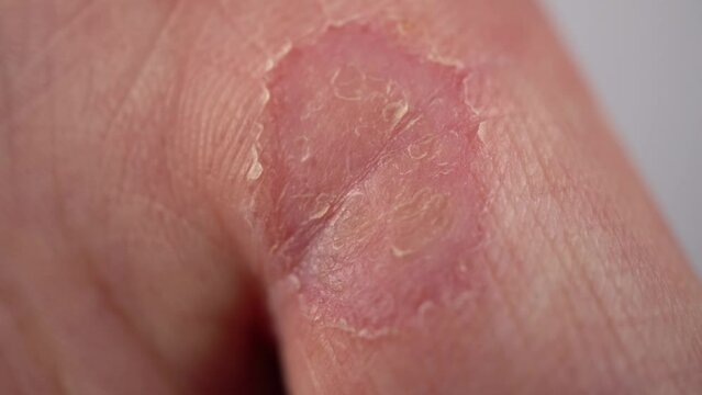 Male hand with callus on the finger close-up. Wart on hand. The skin of the hands lacks vitamins. Macro.