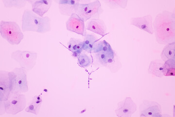 Obraz na płótnie Canvas View in microscopic of Candidiasis, fungus infection (Yeast and Pseudohyphae form) in pap smear slide cytology and diagnostic by pathologist.Gynecology report and diagnosis.Medical concept.