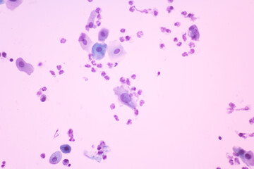 iew in microscopic of Abnormal human cervix cells.Squamous epithelium cells.Superficial and intermediate epithelial cells.Cytology and pathology laboratory department.Magnification 400 X