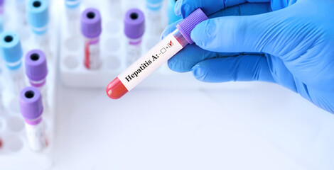 Obraz premium The doctor holds a test blood sample tube positive with hepatitis A virus (HAV) test on the background of medical test tubes