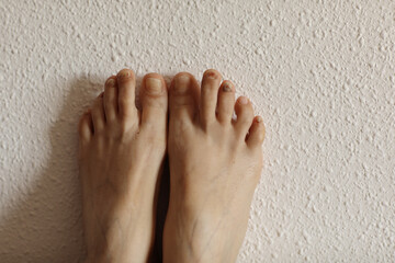 Fototapeta premium Female feet with subungual hematoma, black toenails caused by trauma, fungal infection, chemotherapy. Person suffering from onychomycosis, fungal infection causing yellowing of the toenail. copy space