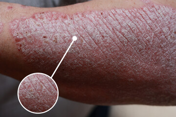 Macro detailed circles magnification of psoriasis skin, autoimmune disease that affects the skin...