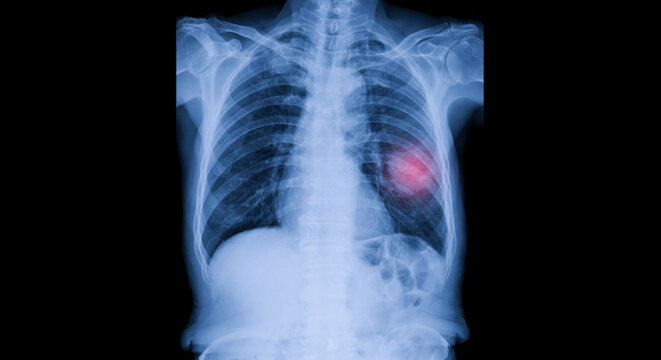Radiograph on dark background in hospital.The x-ray used for diagnosis of the illness of patient.Medical concept.Blue tone xray show mass at left lung with red light.Lung cancer in smoking patients.