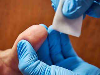 Fototapeta premium Before medical procedures, the wart on the finger is treated with alcohol. Treatment of skin diseases.