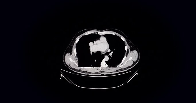 Computed tomography abdomen (CT SCAN)
