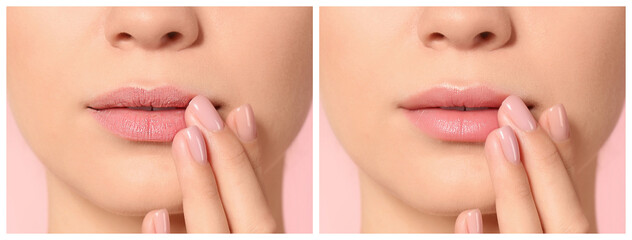 Collage with photos of woman before and after using lip balm on pink background, closeup - obrazy, fototapety, plakaty
