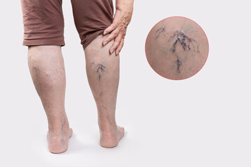 Varicosity. Close up view of old legs of woman with vascular asterisks. Zoomed area with blood vessels. White background with copy space. Back view. The concept of varicose veins
