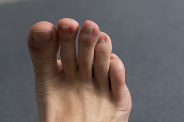 The foot, five toes, of a caucasian male with a damaged toe. Underneath the nail. small round...
