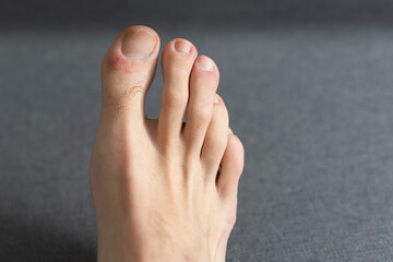 hair and wounds on male toes