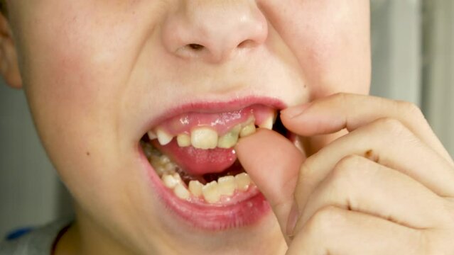 The child shakes the finger of the milk tooth. Mouth open, other teeth are visible. Change of teeth in children. Dental care in children. Pediatric Dentistry