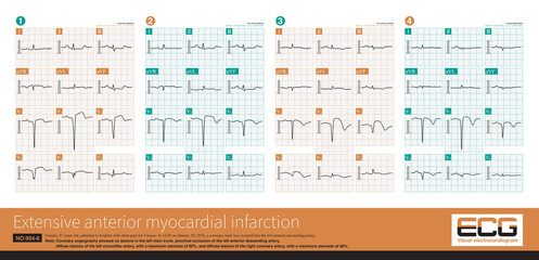 A 67-year-old patient with acute extensive anterior myocardial infarction showed obvious ST-T evolution on the sequence electrocardiogram during hospitalization.
