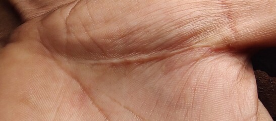 Macro photography of a scar on the palm of a man's hand.