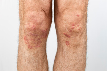 Eczema on knees. Allergic spots and redness of the skin on the legs. Close-up of the legs of a man suffering from psoriasis on a white background.