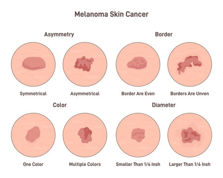 Melanoma cancer. Anatomical infographic poster. Dermatology and oncology