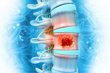 Spine cancer or spinal tumor disease. 3d illustration - obrazy, fototapety, plakaty