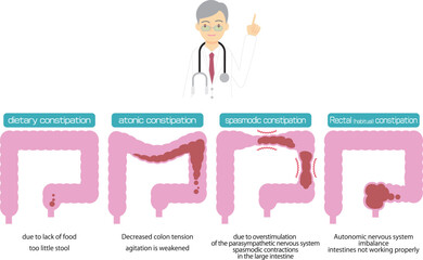 Fototapeta premium 便秘の原因別種類を図解／Illustrated types of constipation by cause