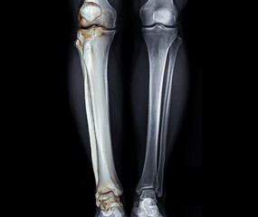 X-ray image of  both Leg  AP view   with 3D leg for diagnostic knee fracrure.