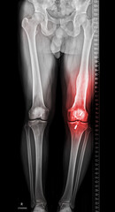 Scanogram is a Full-length standing AP radiograph of both lower extremities including the hip, knee, and ankle.