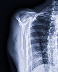 X-ray Shoulder joint shoulder front view for diagnosis fracture of shoulder joint.