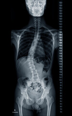 X-ray image of Whole  Spine  for diagnosis scoliosis of spine.