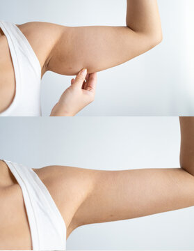 Shown are the before and after results of a brachioplasty operation, also called an arm lift.