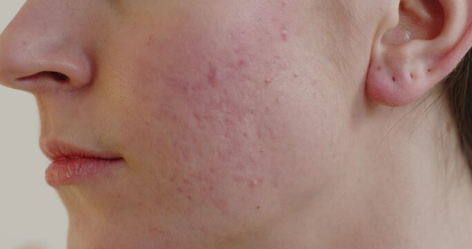 Close up view of woman acne skin caused by hormone
