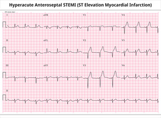 Hyperacute Anteroseptal STEMI (ST-Elevation Myocardial Infarction) - ECG Paper 12 Lead - Vector Medical Illustration