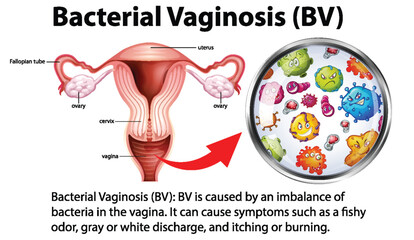 Fototapeta premium Bacterial Vaginosis (BV) infographic with explanation