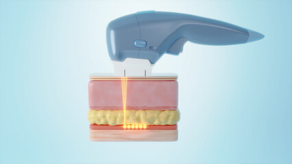 HIFU or Ulthera machine shot laser to SMAS skin. 3D rendering.