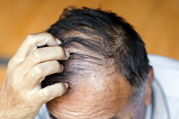 Fototapeta premium Elderly men with hair loss to the point of baldness. Elderly health concept.