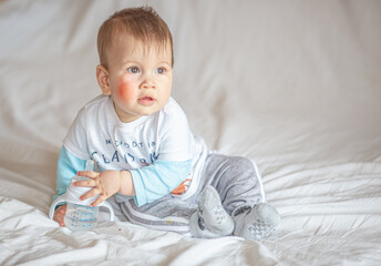 Atopic dermatitis eczema in baby.Condition that causes the skin to become red,dry,sore,itchy and cracked.Atopic eczema most often affects face in children. London England UK,Mart 30 2020 - obrazy, fototapety, plakaty